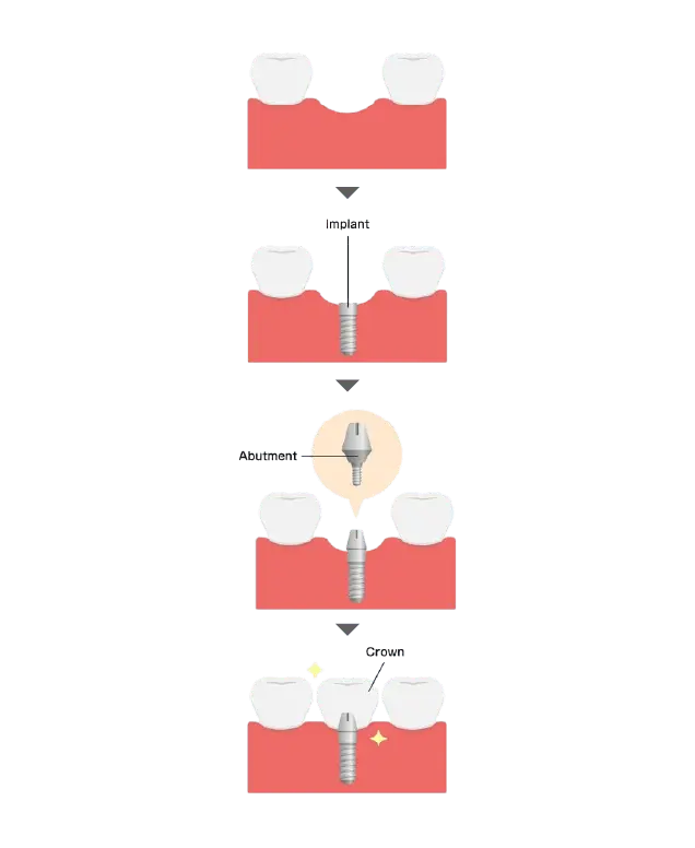 Step-by-Step Dental Implant Procedure in Gurgaon for a Perfect Smile