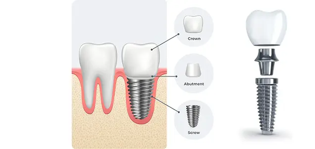 Dental Implants: Everything You Need to Know