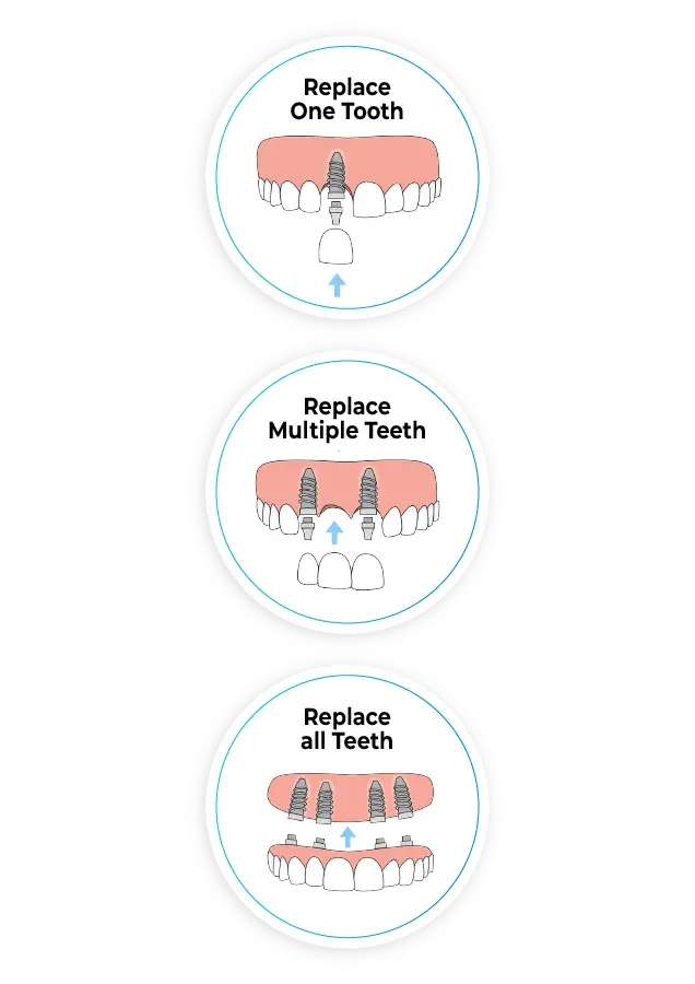 Types of Dental Implants We Provide