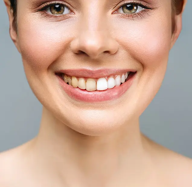 What Causes Teeth Discoloration