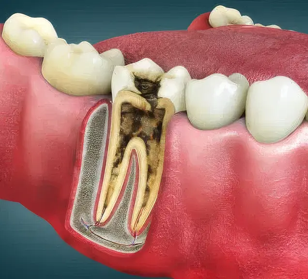 What is Root Canal Treatment