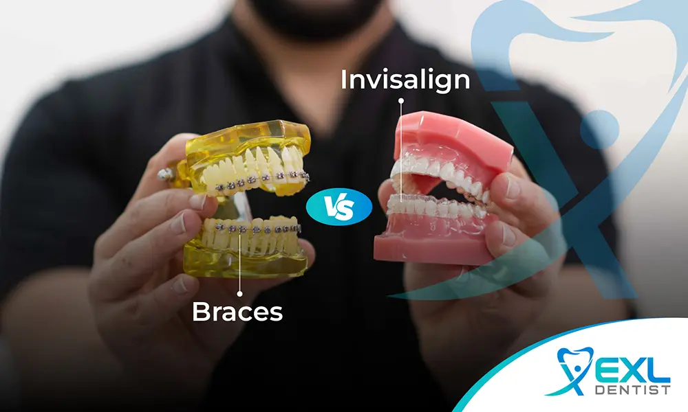 Braces vs Invisalign
