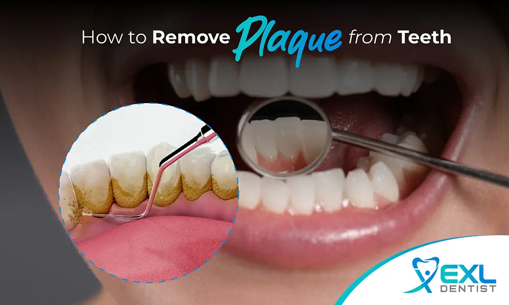 How to Remove Plaque From Teeth