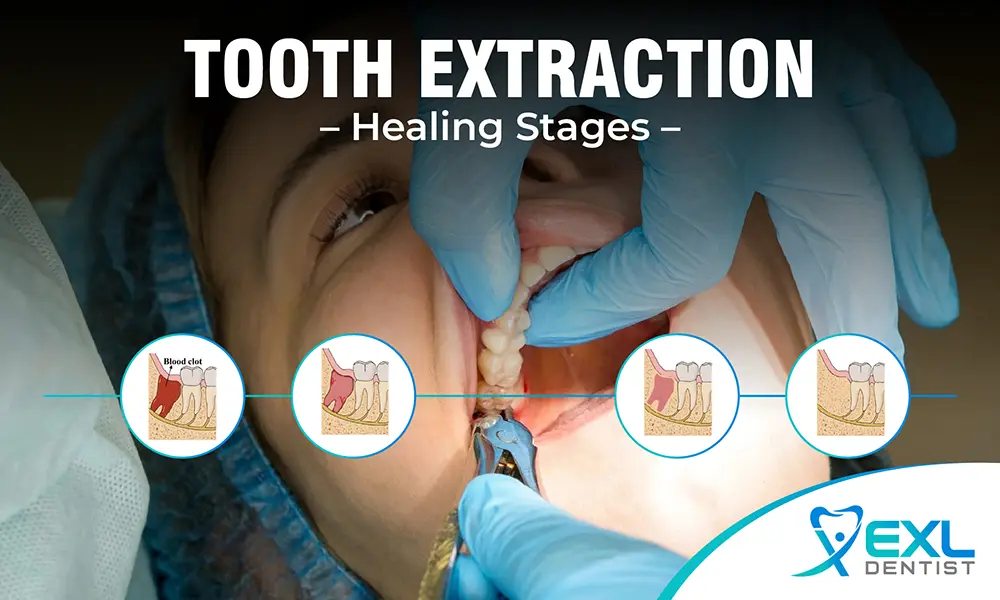 Tooth Extraction Healing Stages