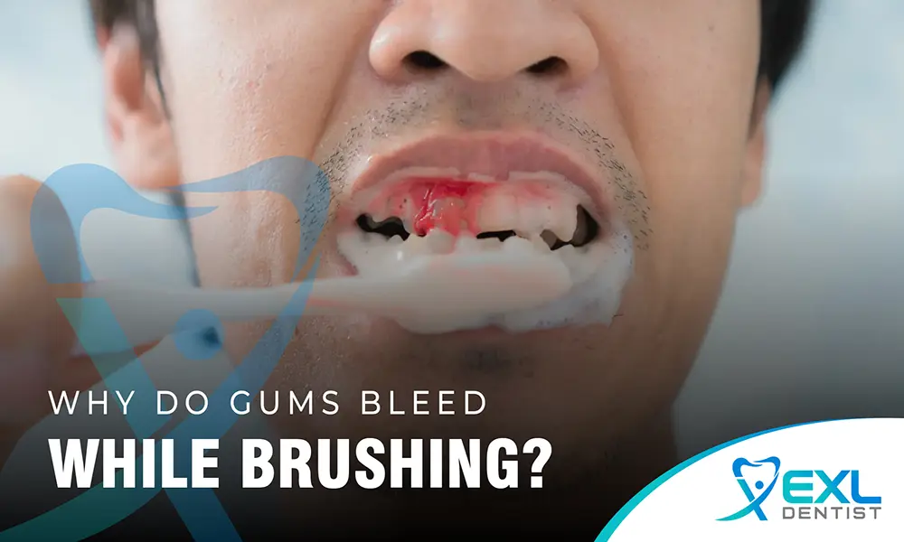 Why Do Gums Bleed While Brushing?